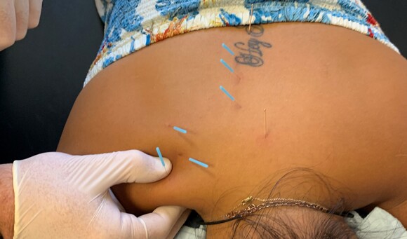 A photo of a therapist with a few needles in a patients back as part of dry needling therapy.