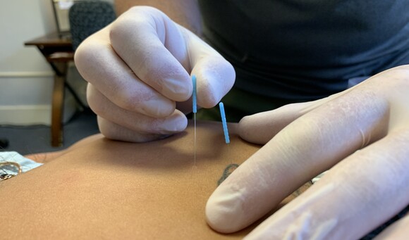 A photo of a dry needling procedure